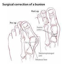 The Bunion Relief and Forefoot Protector Brace "Pair"
